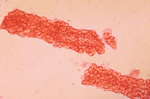 Hyaline Casts In Urine Types Morphology Clinical Significance 6979