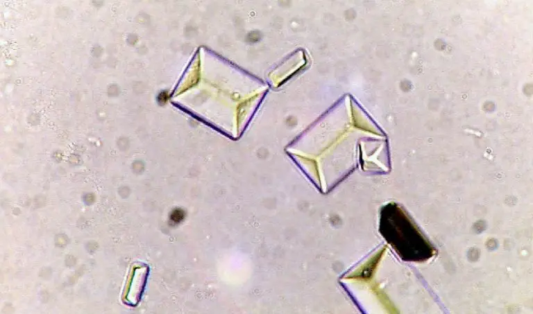 Types Of Crystals Found In Human Urine And Their Clinical Significance 4197