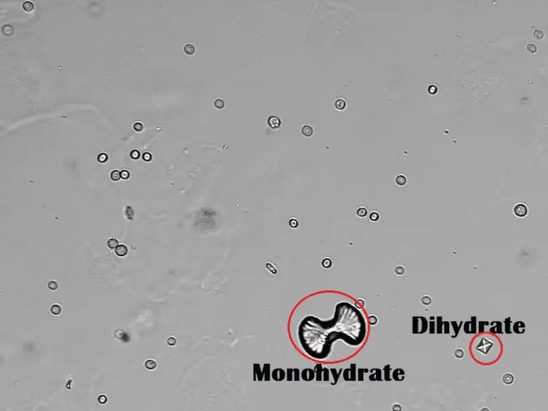 Types of Crystals Found In Human Urine and Their Clinical Significance