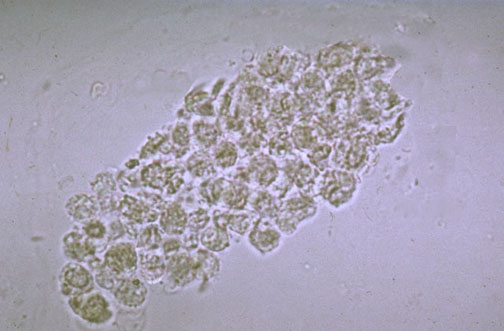 formation of urine Urine Casts Types Their Of And Found Clinical In