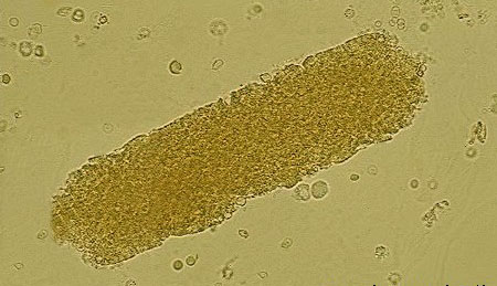 types of casts found in urine and their clinical significance ...