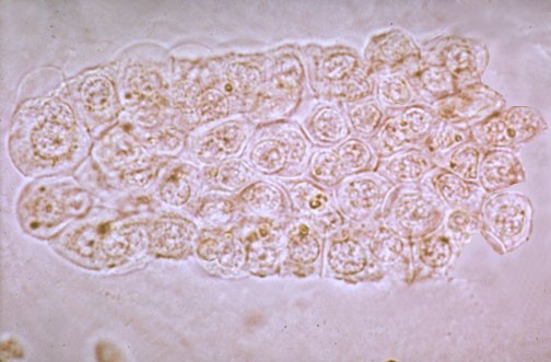 Cellular Cast In Urine