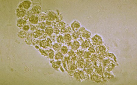 Leukocyte Casts In Urine