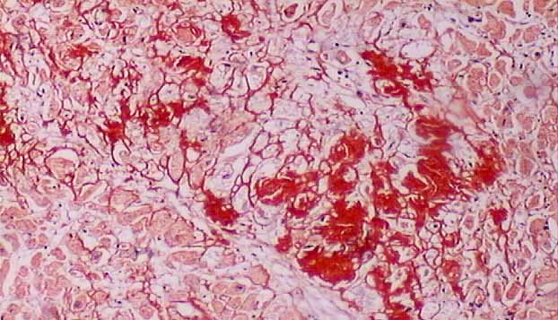 solution of naoh 5 Congo Staining Red Alkaline Technique Amyloid for