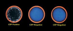 C-Reactive Protein (CRP) Test : Introduction, Principle, Procedure and Interpretation