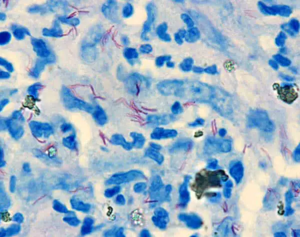 wade-fite-stain-mycobacterium-leprae