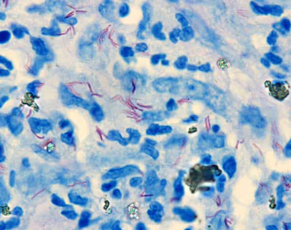 wade-fite-staining-technique-for-mycobacterium-leprae-laboratoryinfo