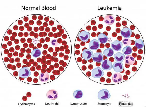mean platelet volume in a patient with a normal blood and a patient with leukemia