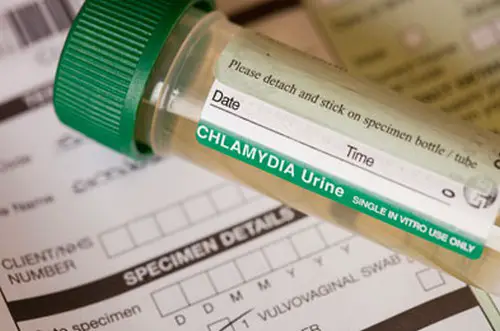 urine test chlamydia