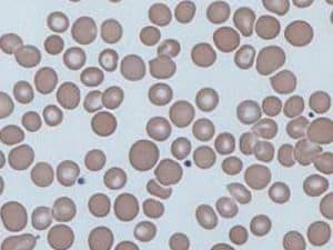 What is Anisocytosis ? Causes, Types and Vs Poikilocytosis