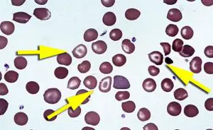 Target Cells – Causes, Examples and Images