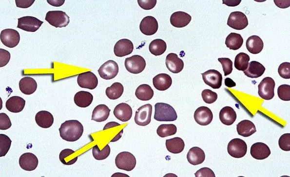 Target Cells - Causes, Examples and Images - Laboratoryinfo.com