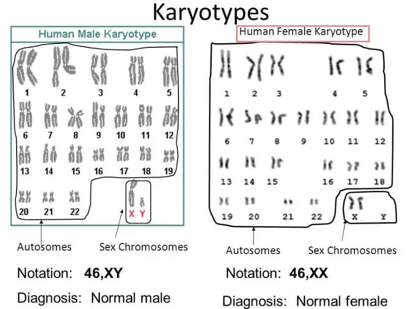 Karyotype Down Syndrome Male Captions Todays