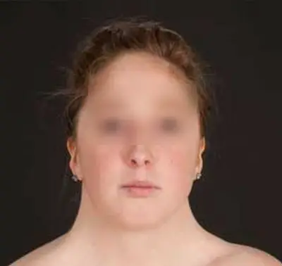 Physical traits of a person living with Turner syndrome