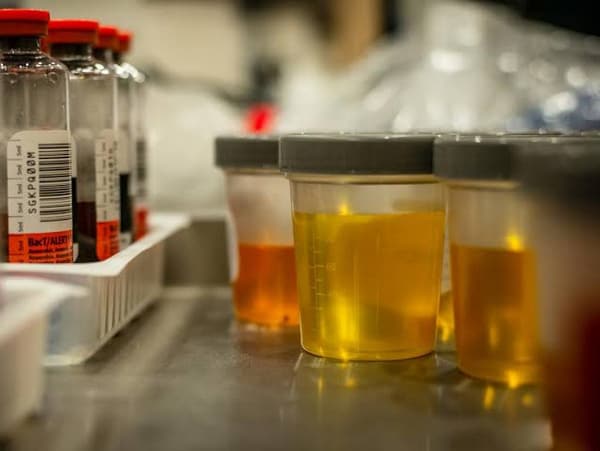 Urinalysis Urine Testing Types Process Results Interpretation Reference Charts 4971