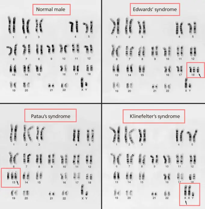 karyotyping images of common disorders with chromosomes