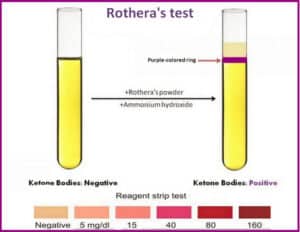 Rothera’s Test (Urine ketone bodies test) – Procedure, Principle and Results