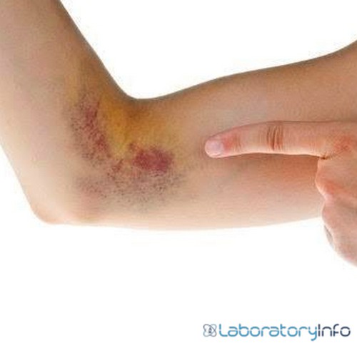 Figure shows the area of arm affected with hematoma