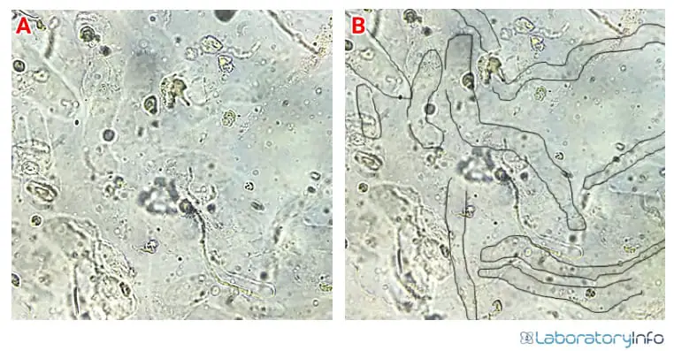 Waxy Cast Urine