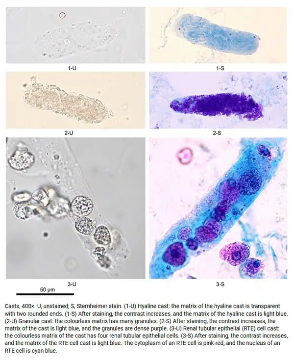 Hyaline Casts In Urine Causes Normal Range And High Levels Significance Microscopic Images 1603